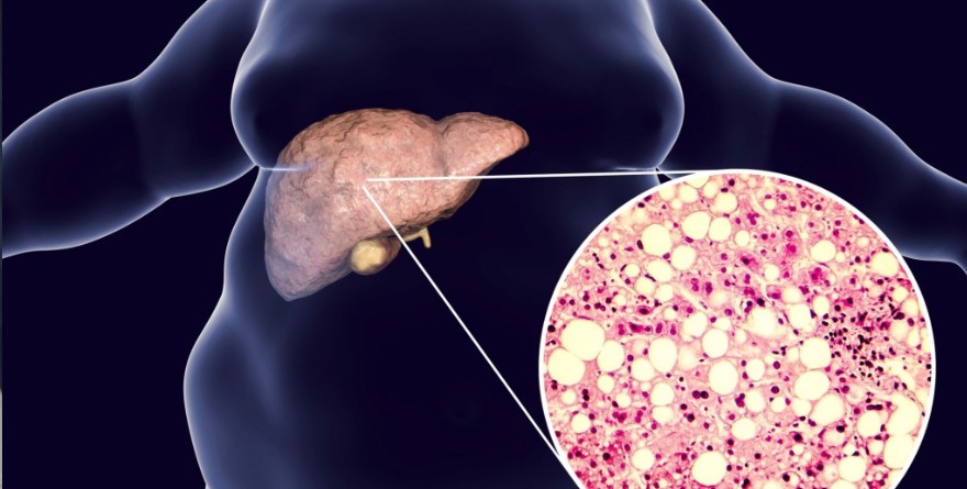 Recomienda IMSS Veracruz Norte alimentación saludable para prevenir hígado graso