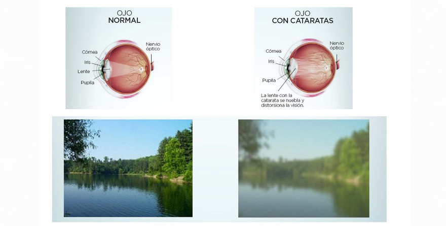 CATARATAS: MÁS FRECUENTES Y CADA VEZ MÁS TEMPRANAS