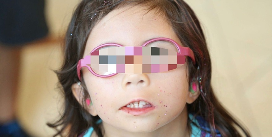 SÍNDROME DE MOEBIUS