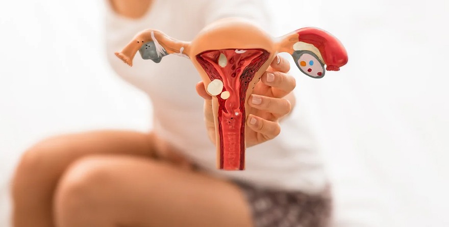 DETECIÓN OPORTUNAMENTE ENDOMETRIOSIS